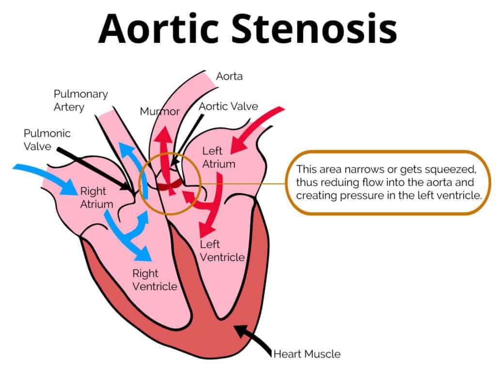 Aortic Stenosis Rev